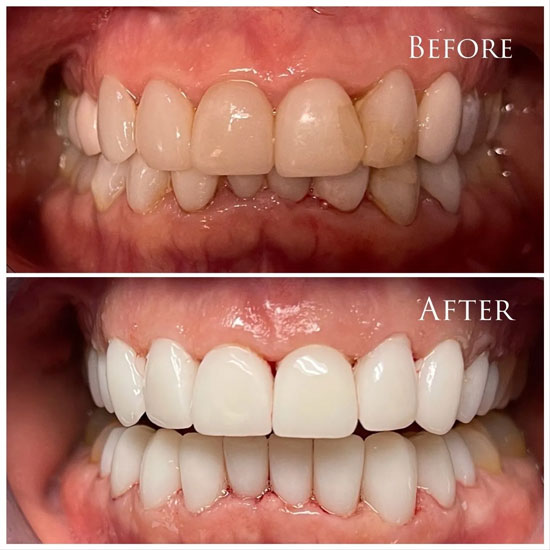 Cosmetic Crown Before and After