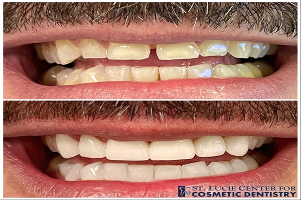 Cosmetic Crowns In Port St  Lucie, FL