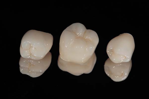 Questions To Ask About Dental Crowns