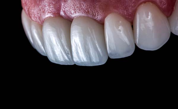 Understanding The Dental Veneers Process