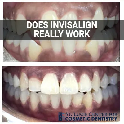 Visit our Does Invisalign Really Work page