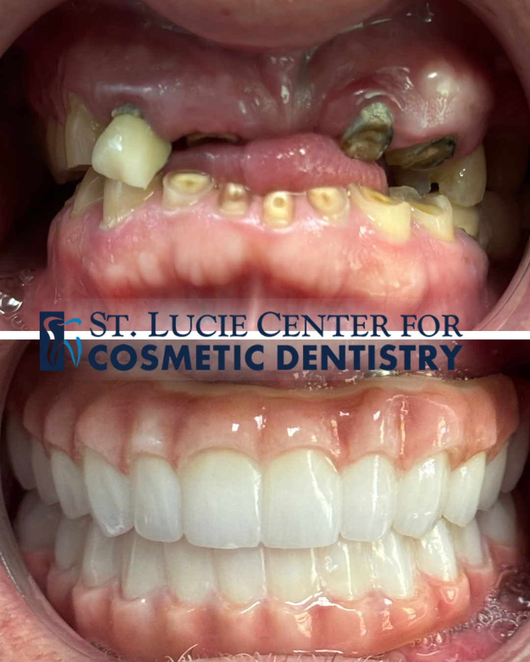 Full mouth dental implants diagram showing titanium posts and replacement teeth