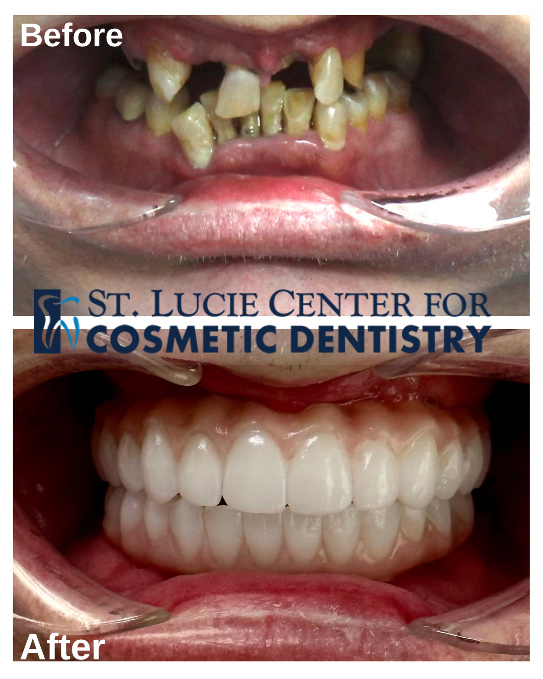 Before and after dental implant transformation