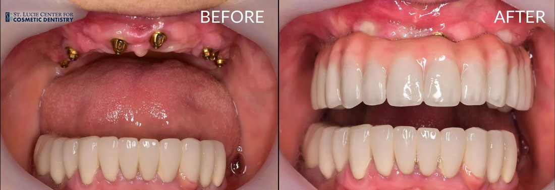 Implant Denture Before and After