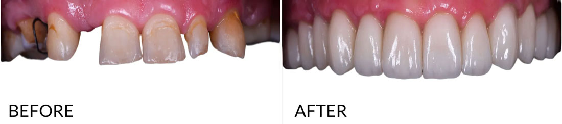 Implant Denture Before and After