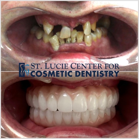 Implant Denture Before and After