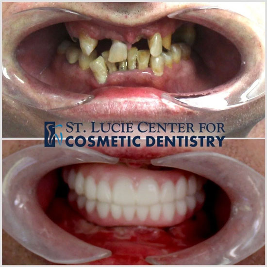 Implant Denture Before and After