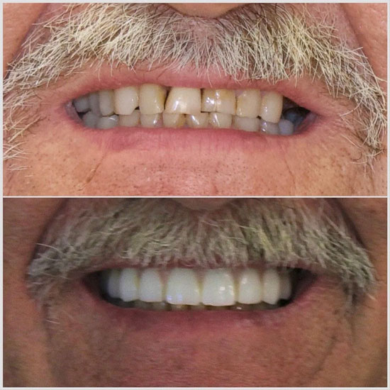 Implant Denture Before and After