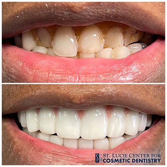 Implant Denture Before and After