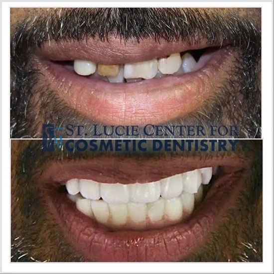 Implant Denture Before and After