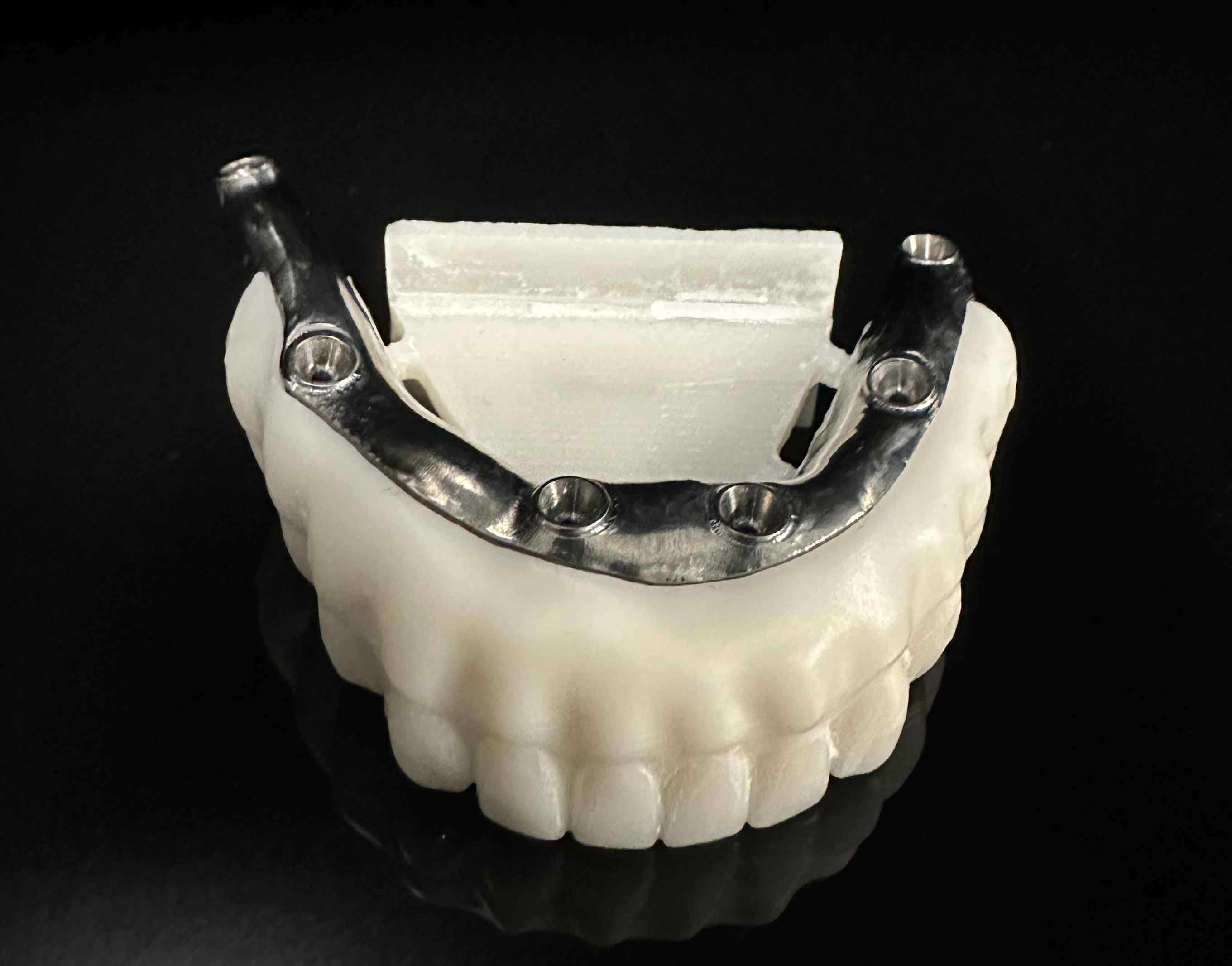 implant supported dentures metal bar