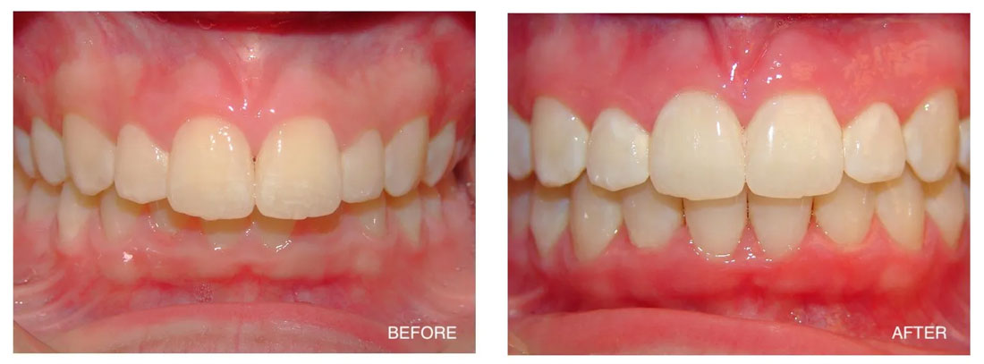 Invisalign Before and After