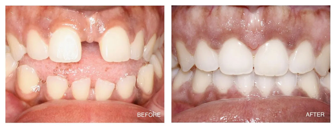 Invisalign Before and After