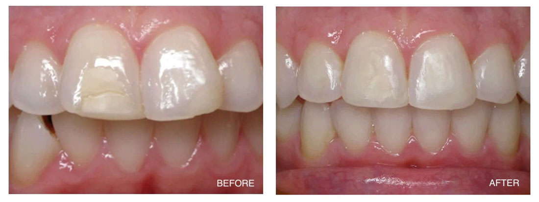 Invisalign Before and After