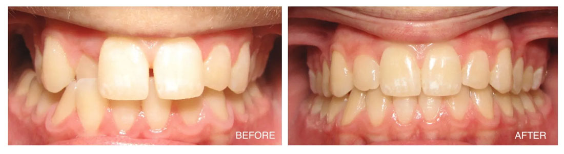 Invisalign Before and After