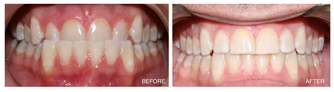 Invisalign Before and After