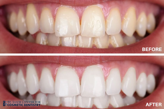 teeth whitening before and after