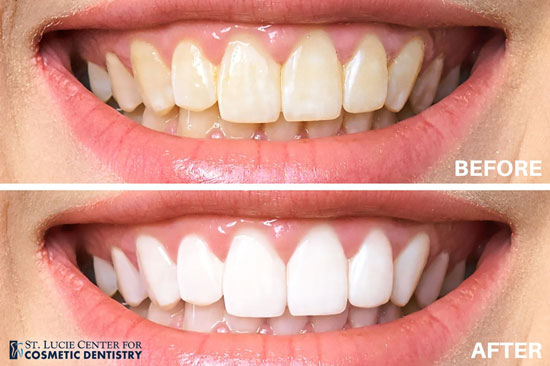 teeth whitening before and after