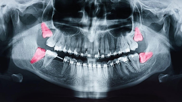 Wisdom Teeth Removal In Port St  Lucie, FL